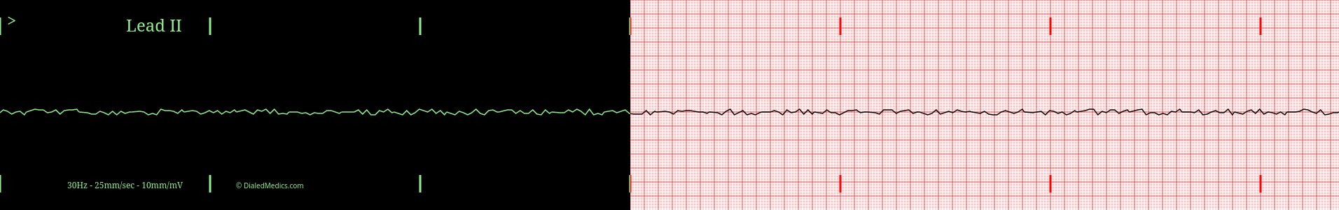 Practice Asystole ECG.