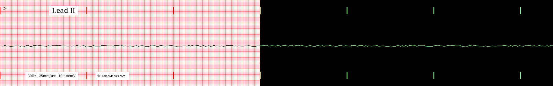 Asystole practice EKG.