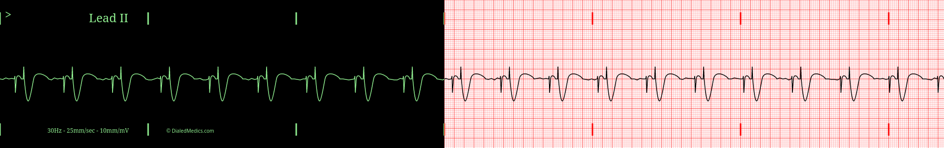 Example of AV Pacemaker ECG tracing.