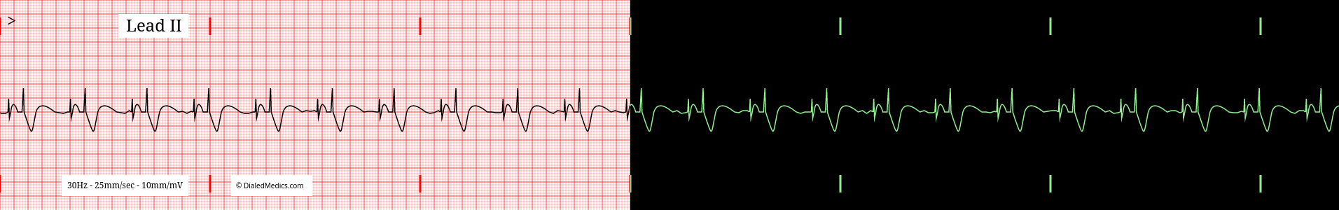 Practice EKG of total sequential AV Pacing.
