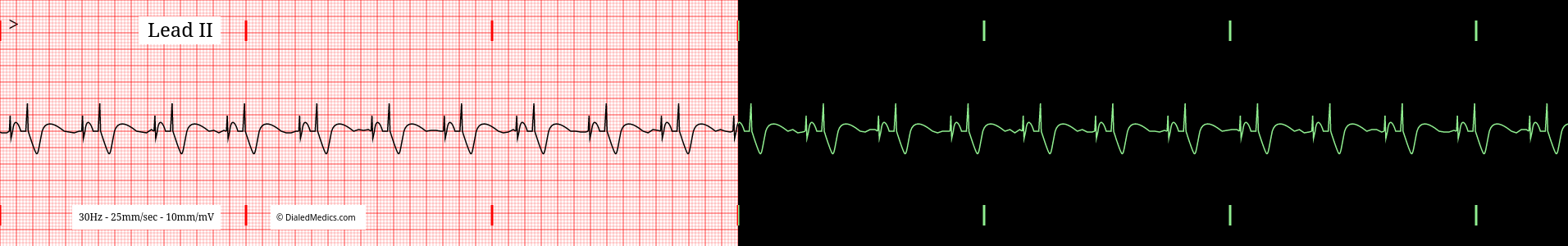 pacemaker av sequential ekg