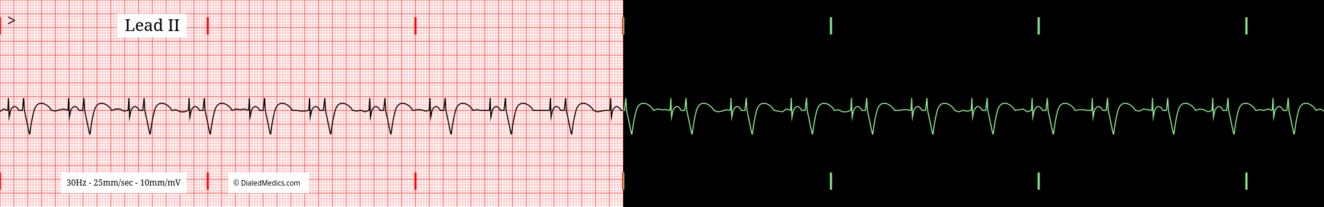 Practice EKG capture of Atrio-Ventricular Pacemaker rhyhtm.