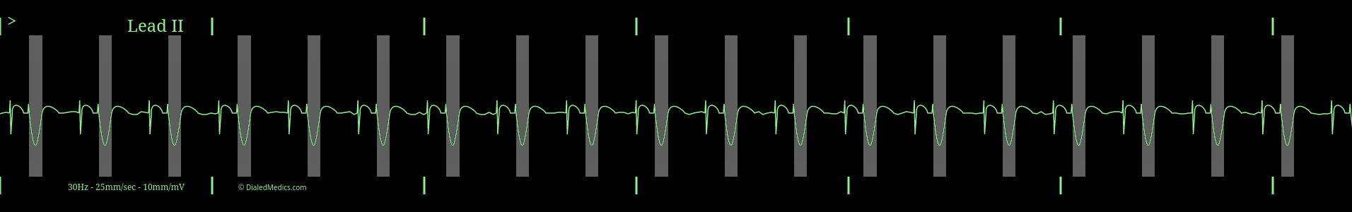 AV Paced ECG capture with the paced ventricular complexes highlighted in grey.