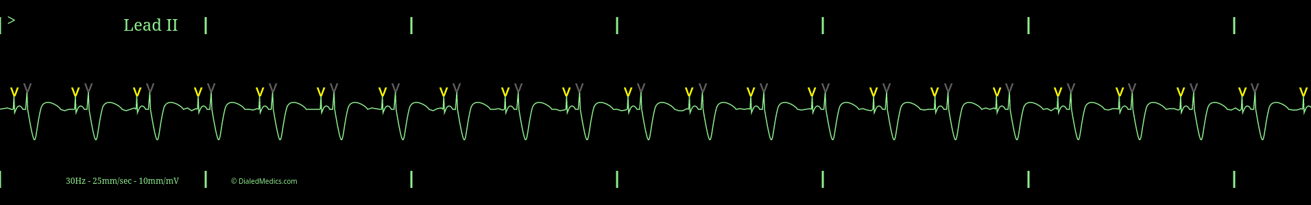 ECG Monitor capture showing AV Pacemaker with pacer spikes marked in yellow and grey.