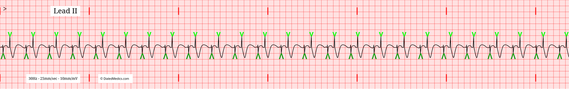 Atrio-Ventricular paced rhythm with pacer spikes marked in green.