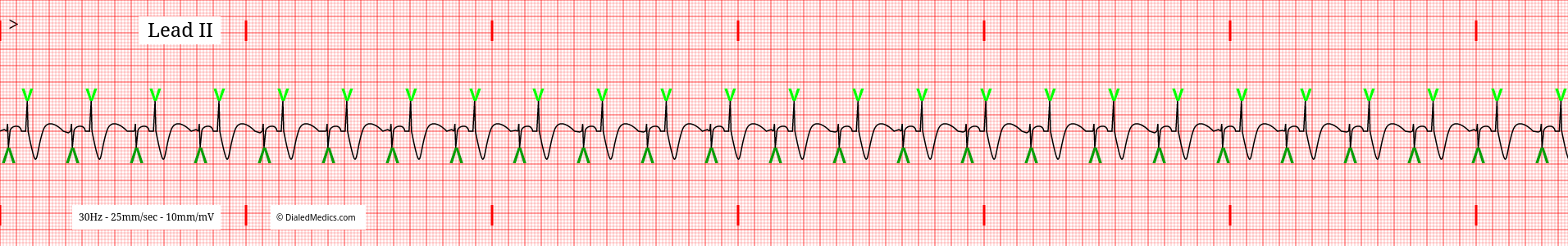 The Atrio-Ventricular Pacemaker EKG/ECG