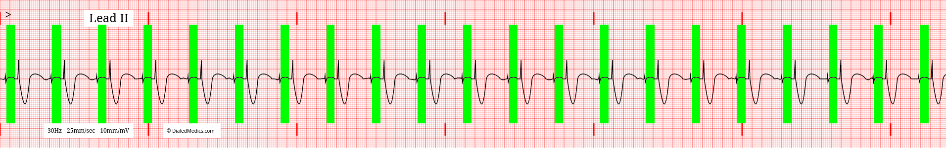 ECG of an Atrioventricular Pacemaker with the artificial P Wave highlighted in green.