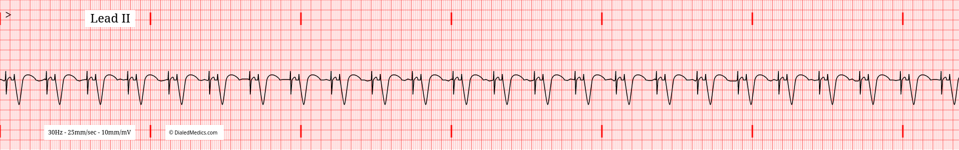 AV Paced rhythm tracing with a HR of 74.