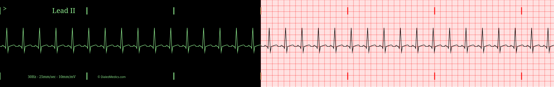Sinus Tachycardia EKG example, split printout / monitor display.