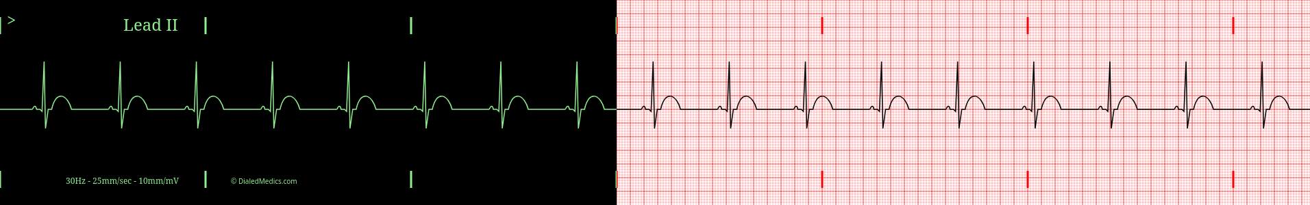 Sinus Bradycardia EKG example, split printout / monitor display.