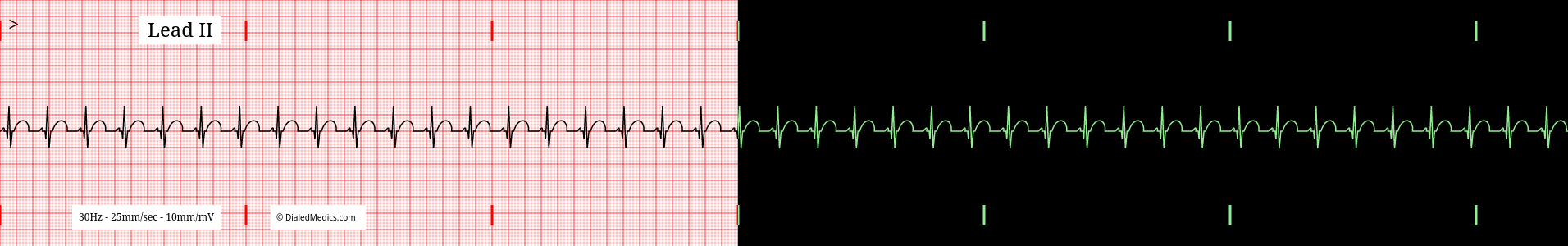 Sinus Tachycardia ECG example, split printout / monitor display.
