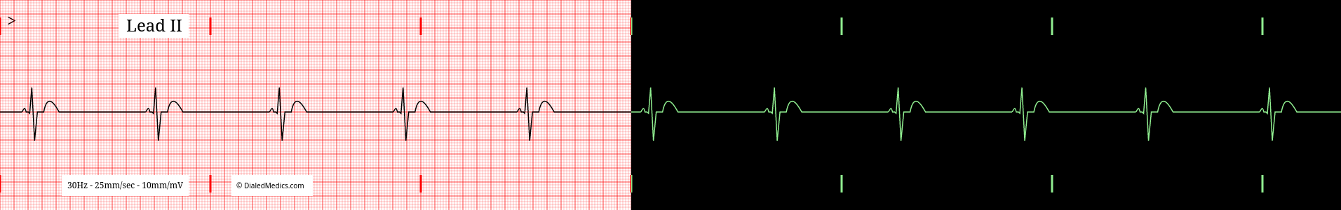 Sinus Bradycardia ECG example, split printout / monitor display.
