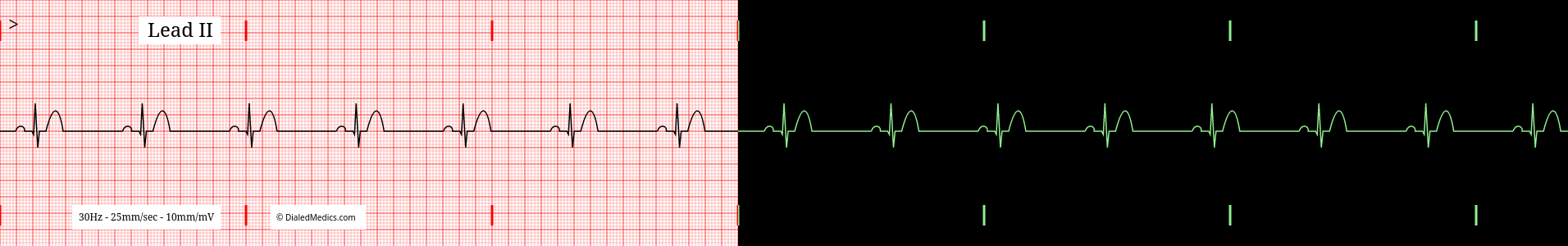 Sinus Bradycardia EKG example, split monitor / paper display.