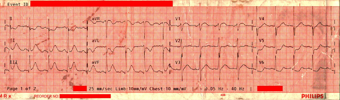 12-Lead EKG showing marked STE in Leads II, II, and aVF, indicative of IWMI.