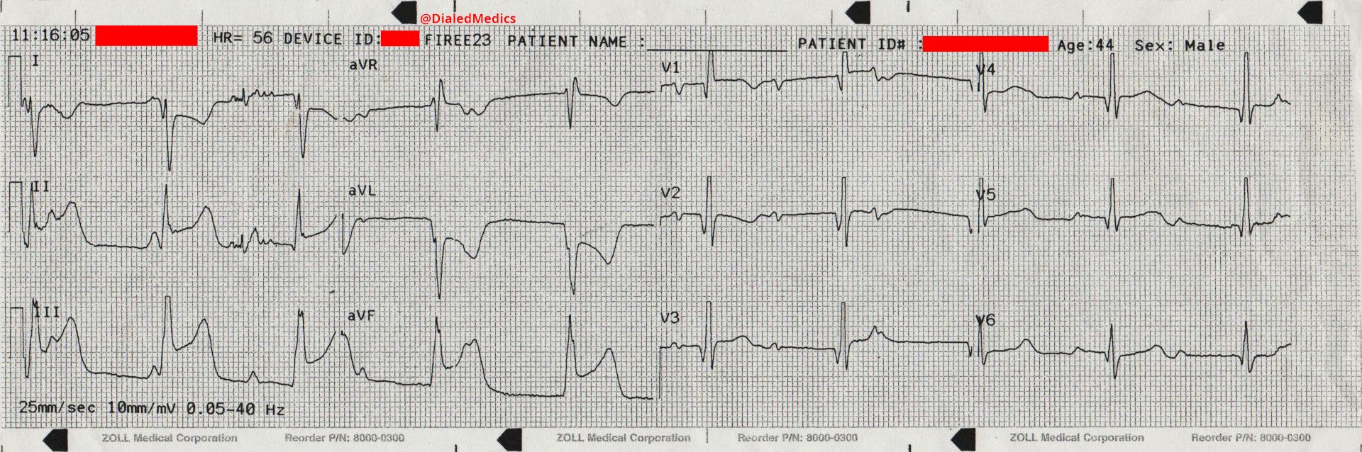 12-Lead EKG showing marked ST elevation in Leads II, III, and aVF.