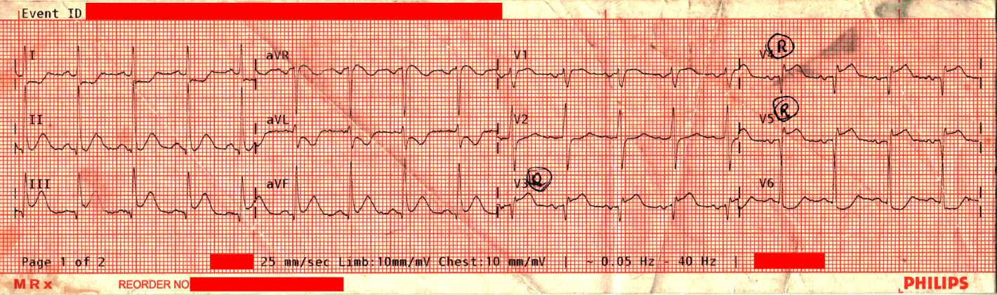 Right sided 12-Lead (15-Lead) with marked STE in v3R, v4R, and v5R.