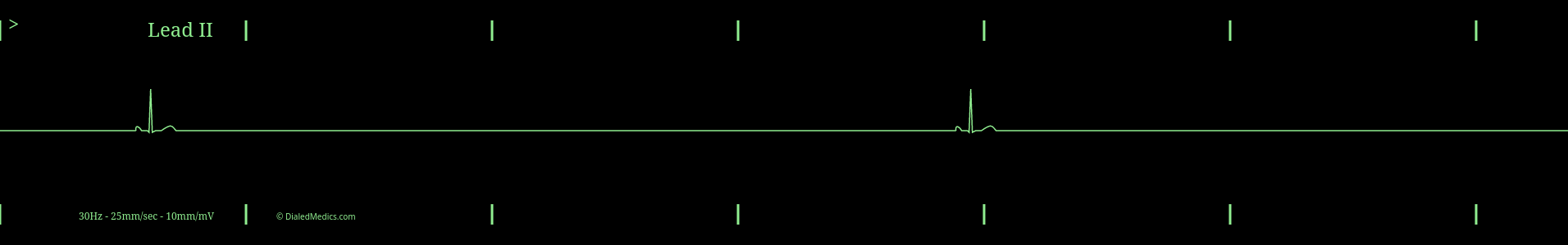 Cardiac Monitor capture of an Agonal Sinus Rhythm (Sinus Bradycardia @ 6bpm).