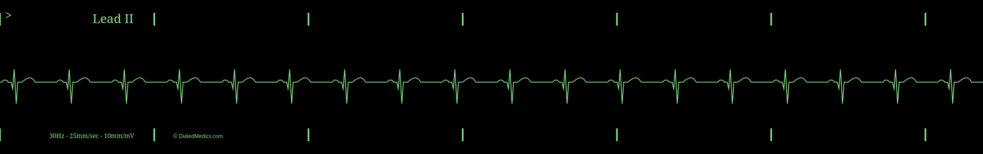 Sinus Bradycardia tracing graph.