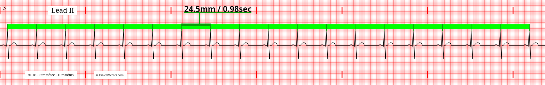 EKG tracing of Sinus Bradycardia at the maximum rate of 59bpm.