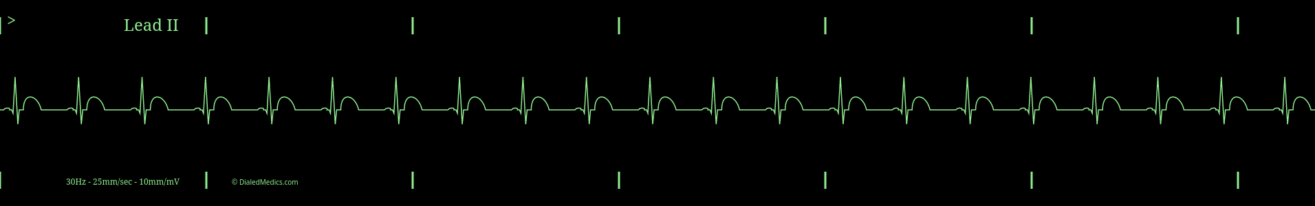 Cardiac monitor capture of Regular Sinus Rhythm at 65bpm.
