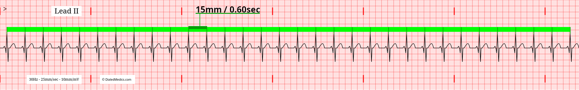 Sinus Tachycardia with its minimum HR of 100bpm.