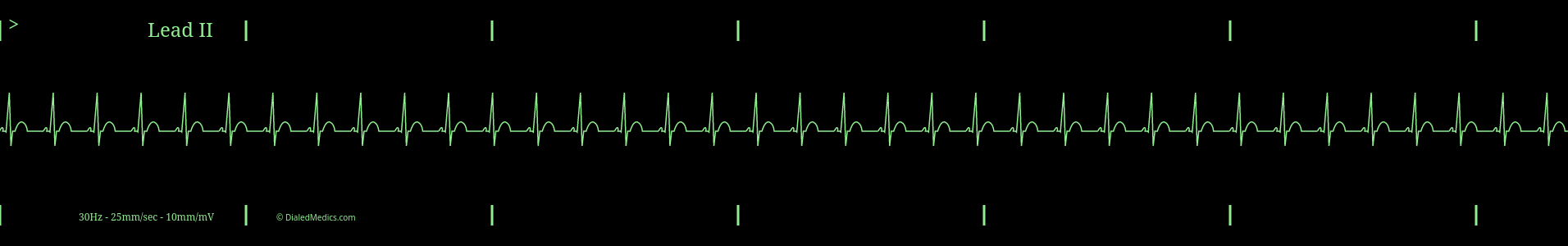 Sinus Tachycardia ECG monitor capture.