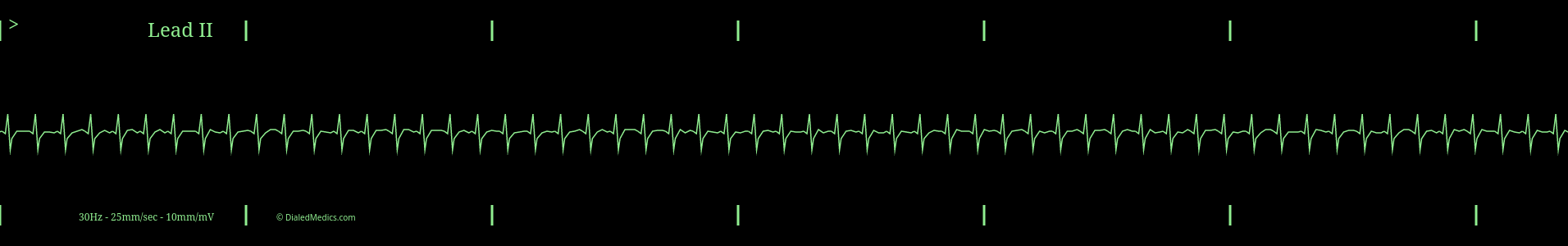 Supraventricular Tachycardia (SVT) ECG monitor capture.