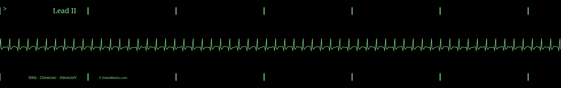 Narrow Complex Tachycardia (SVT) with a HR of 192.