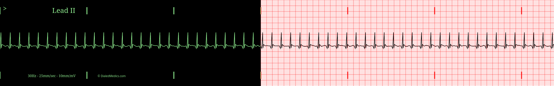 SVT ECG example.