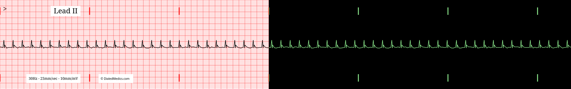 Example Supraventricular Tachycardia EKG.