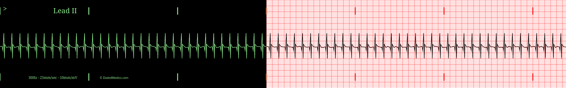 SVT practice EKG tracing.