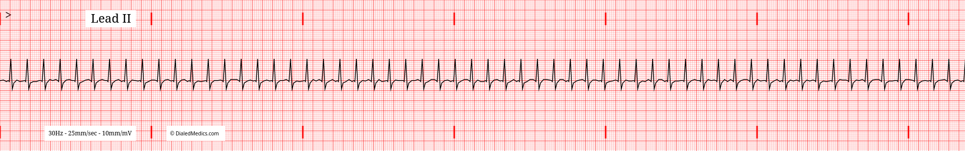 EKG tracing of Supraventricular Tachycardia.