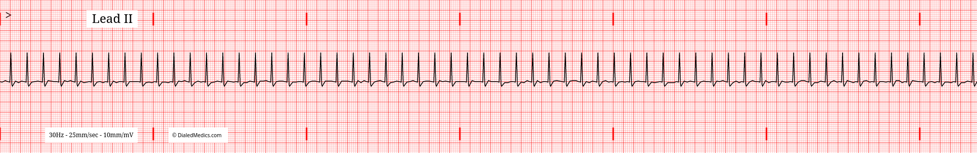 EKG tracing of SVT with a HR of 188bpm.
