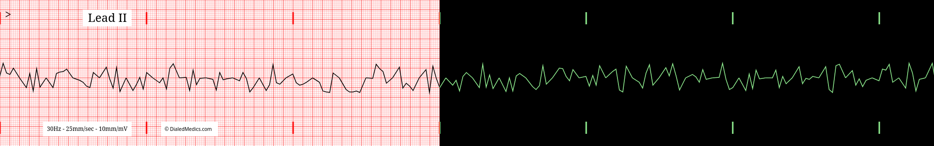 Ventricular Fibrillation practice EKG.