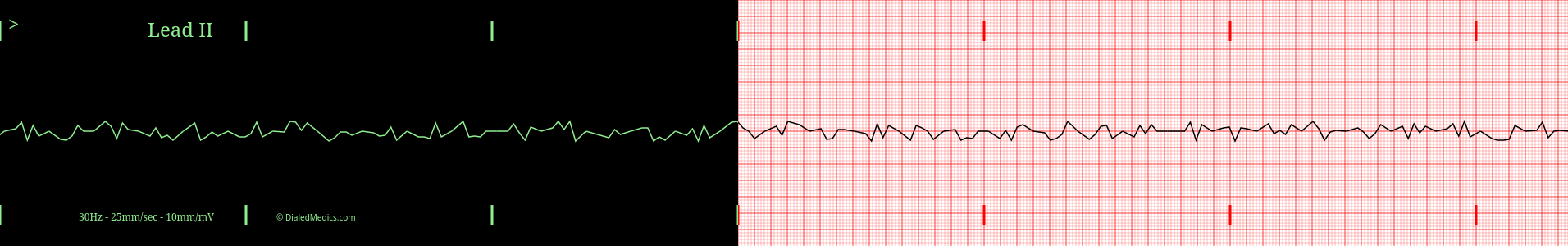 Practice ECG of VFib.