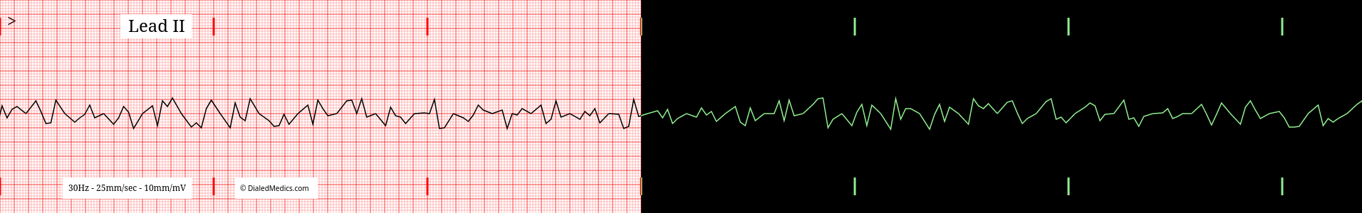 Practice VF EKG tracing.