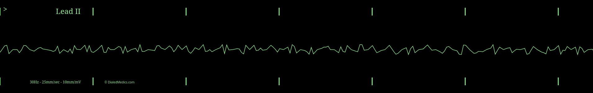 A typical Ventricular Fibrillation ECG monitor capture.