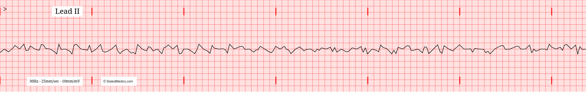 A typical VF EKG tracing.