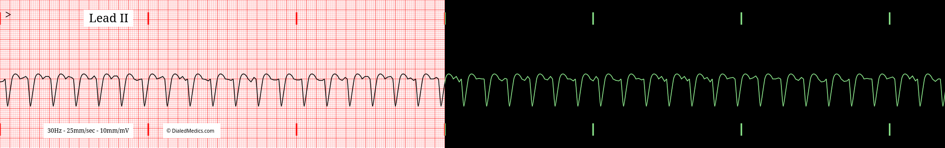 VTach practice EKG tracing.