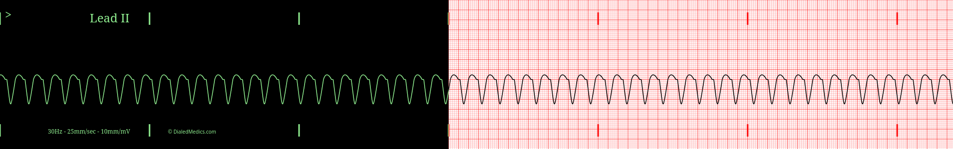 Ventricular Tachycardia practice EKG tracing.