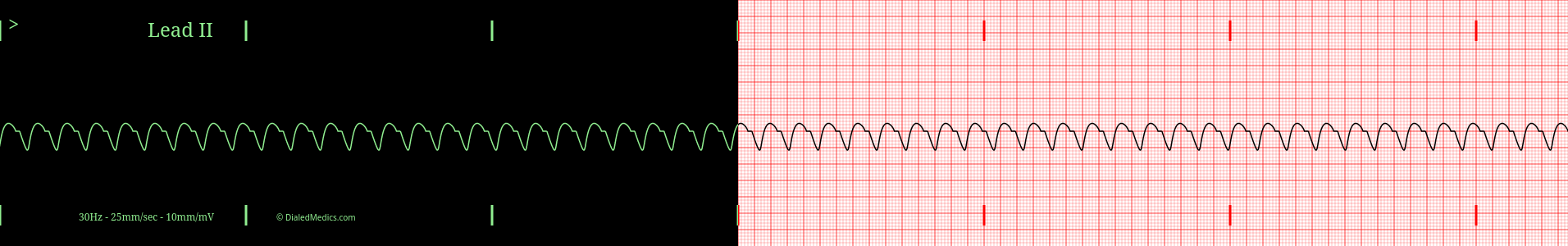 VT practice ECG tracing.