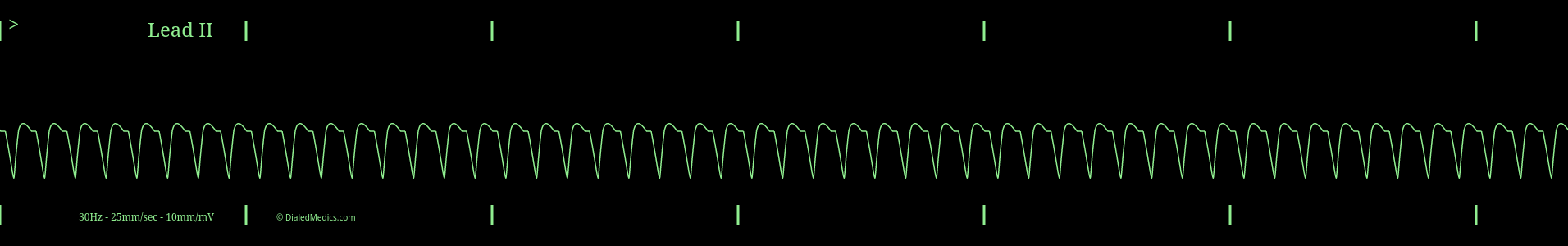 Software generated AFib EKG monitor capture with HR of 160.