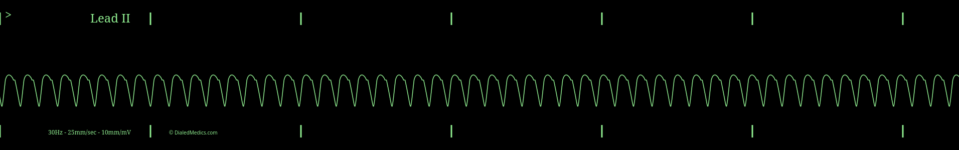 A Typical VTach ECG monitor capture with a regularly regular rhythm.