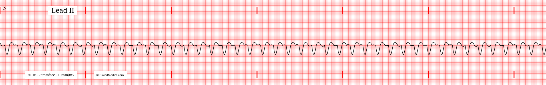 A typical Ventricular Tachycardia EKG tracing.