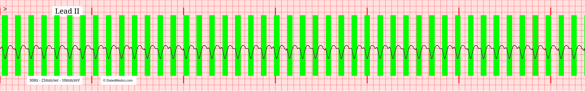 Ventricular Tachycardia with wide QRS complexes highlighted in green.