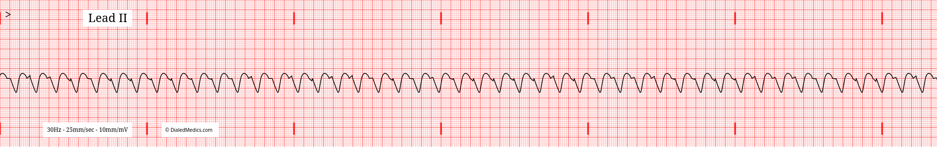 VT ECG tracing with a rate of 146bpm.