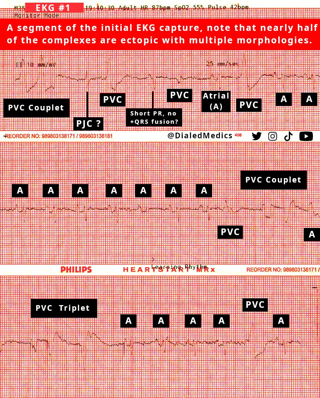 EKG #1 showing the pre-arrest period. Sinus rhythm with significant amounts of non-conducting polymorphic ventricular contractions.