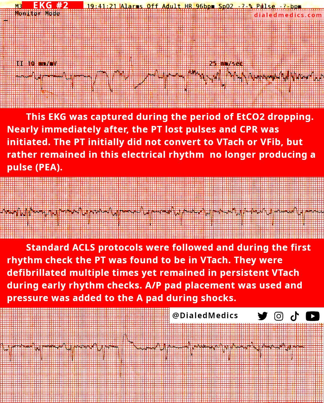 EKG #2 showing the degredation into PEA with a loss of palpable pulse and drop in EtCO2.