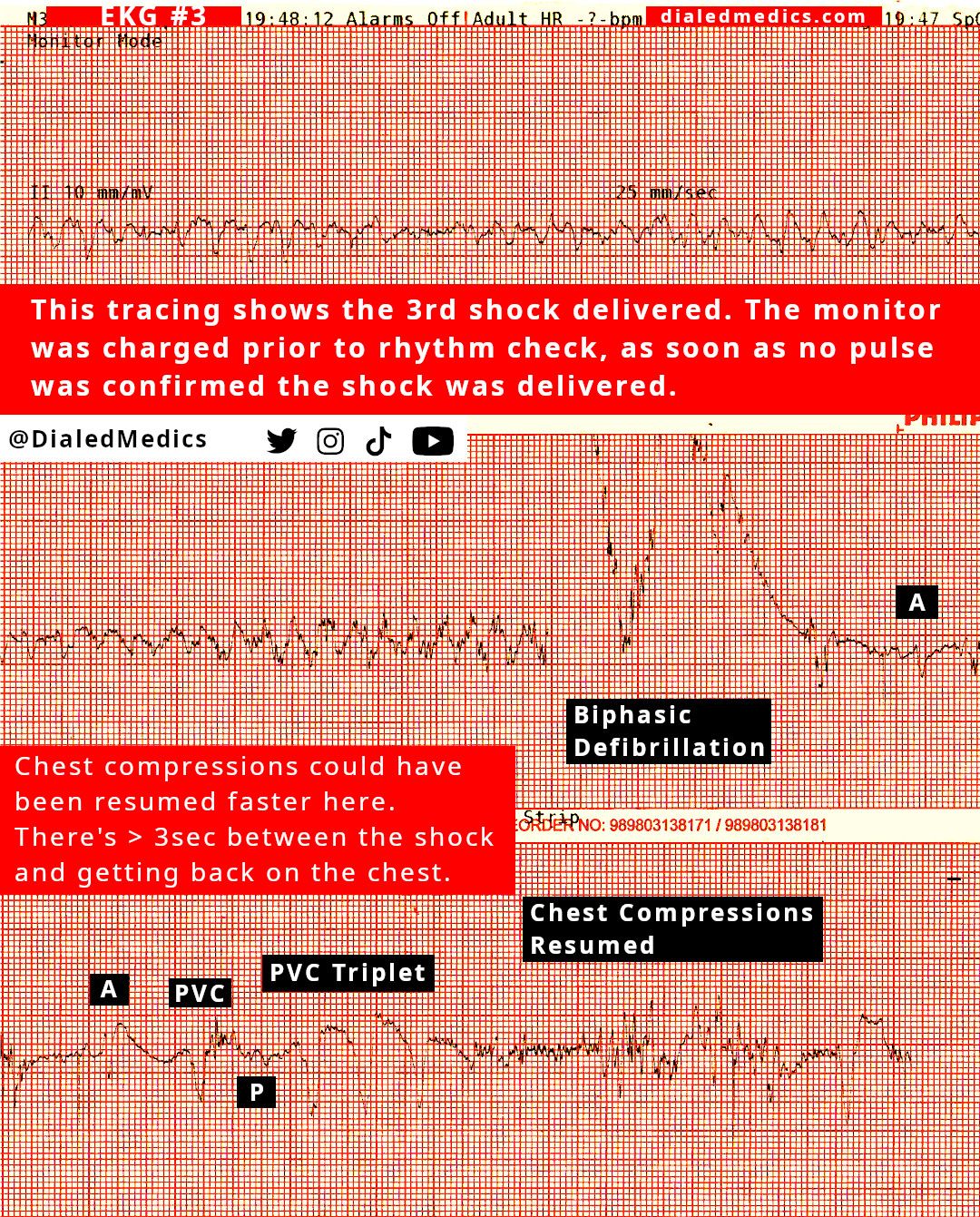 EKG #3 showing biphasic defibrillation #3 with an electrical conversion after.