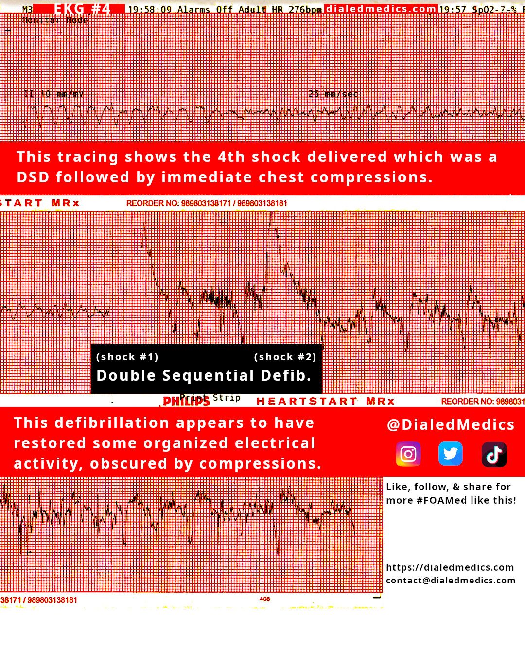 EKG #4 Showing a double sequential defibrillation (shock #4).